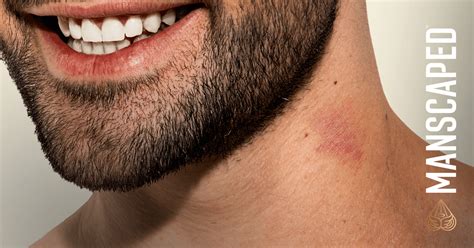 how long to hickeys last|how to heal hickey.